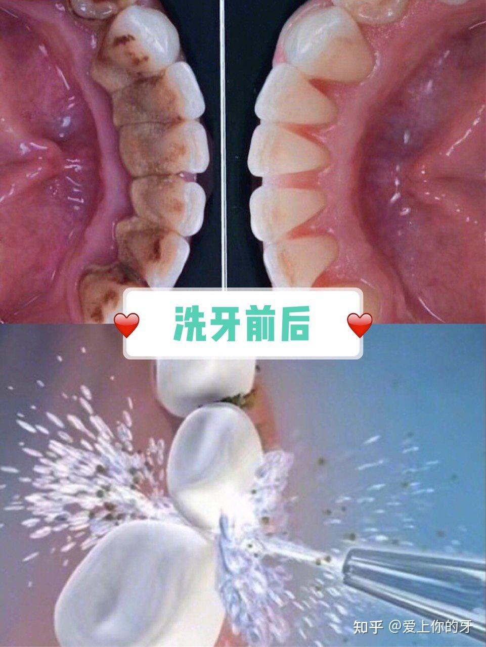 吉安洗牙可以用医保吗(洗牙可以用医保吗,报销比例多少)